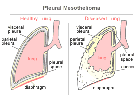 mesothelioma-diagnosis-pleural.gif 