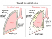 mesothelioma-diagnosis-pleural.gif