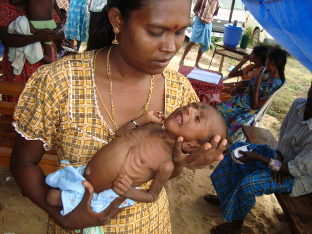 3_months_old_baby_with_severe_malnutrition.jpg 