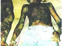 victims_of_chemical_weapon_attacks.jpg