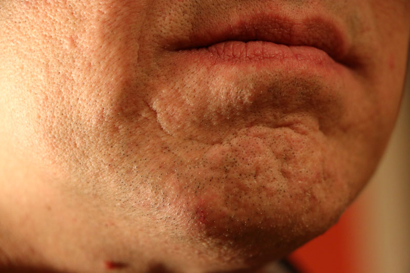abrasion-2.jpg 