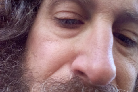 photo of student victim's swollen low lip, jaw, nose 4 days after attack by Lupe