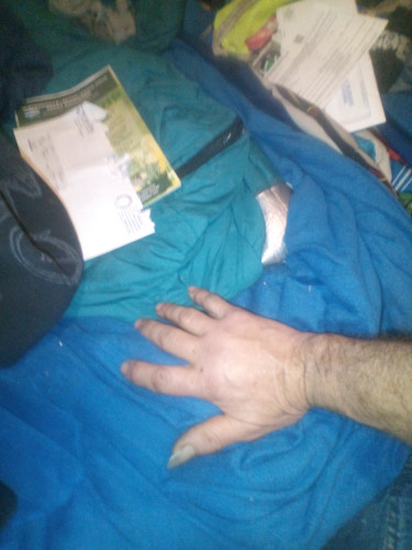 victim is righthanded and was incapacitated for almost a week